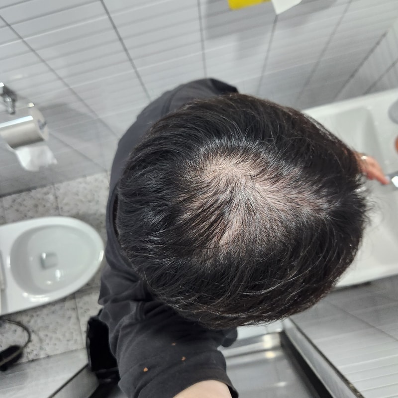 오늘 정수리 사진 찍어보고 놀라서 가입했습니다 정보 부탁드립니다ㅠㅠ