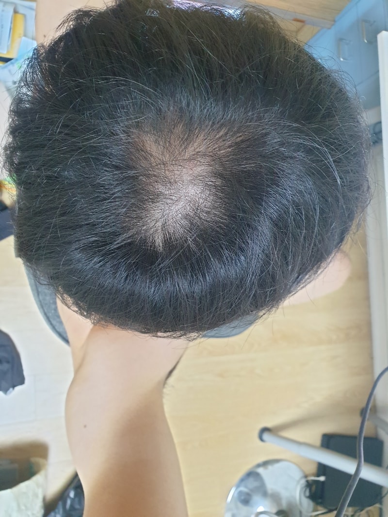 薄毛のせいで人生がとても辛いです。