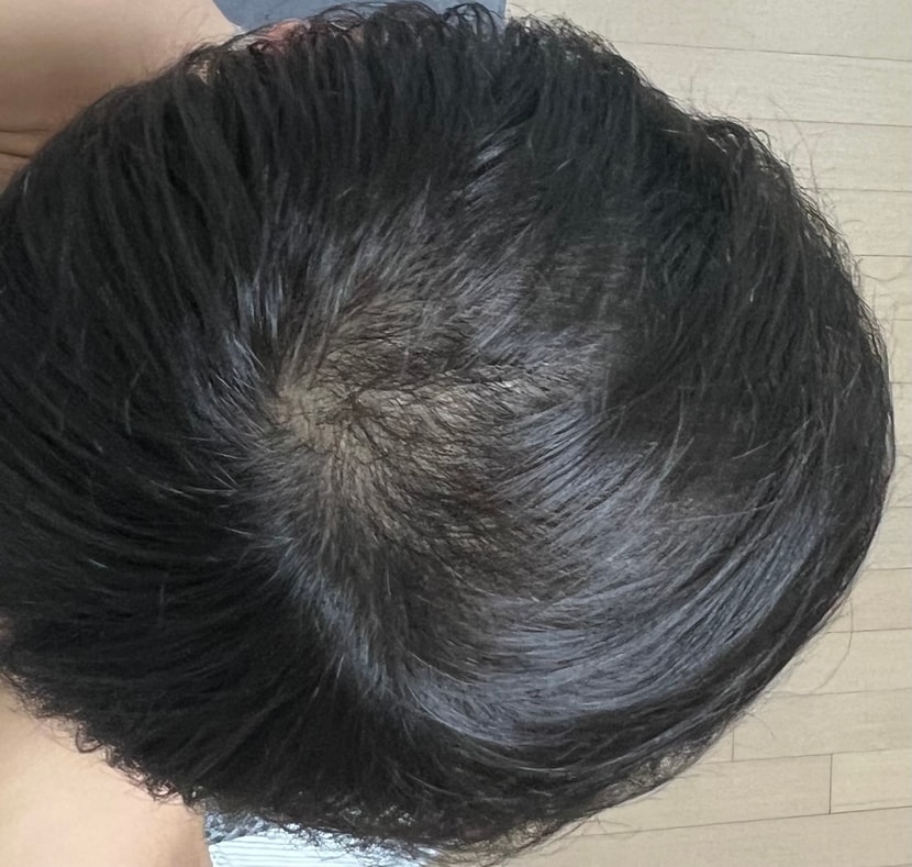 2년전 탈모 관리 4개월차 