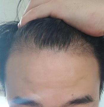 프로스카3주차 미녹시딜2주차