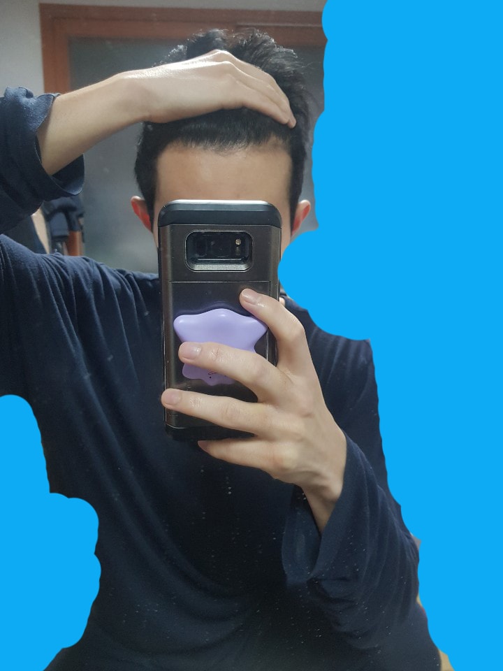 탈모평가 부탁드립니다...30대중반이고 10년넘게 약 먹었습니다.