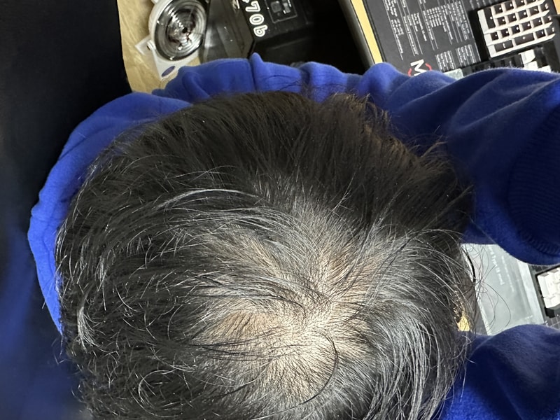 39歳、薄毛が来ました