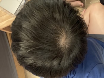 이건 현재 5년뒤 정수리 아이폰 기본 카메로 최대한 현실적으로 촬영 했어요