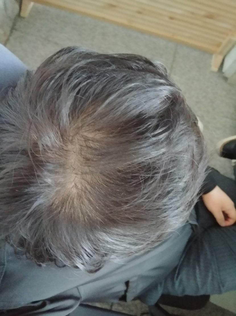 2018.01 .11  : 탈모의 시작