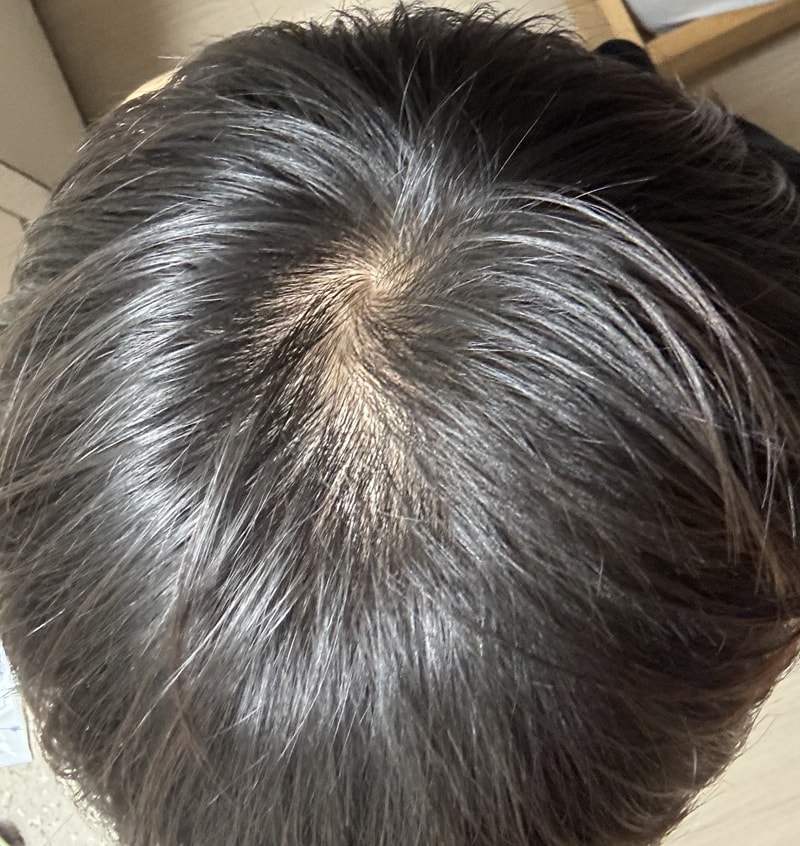 탈모수다