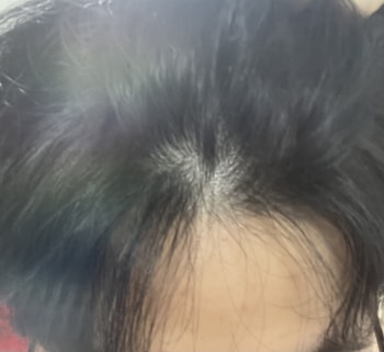 특히 가장 고민되는 부분인 가르마 부분 숱털림 증상입니다. 저기가 하얘지는 게 가장 스트레스더라고요…