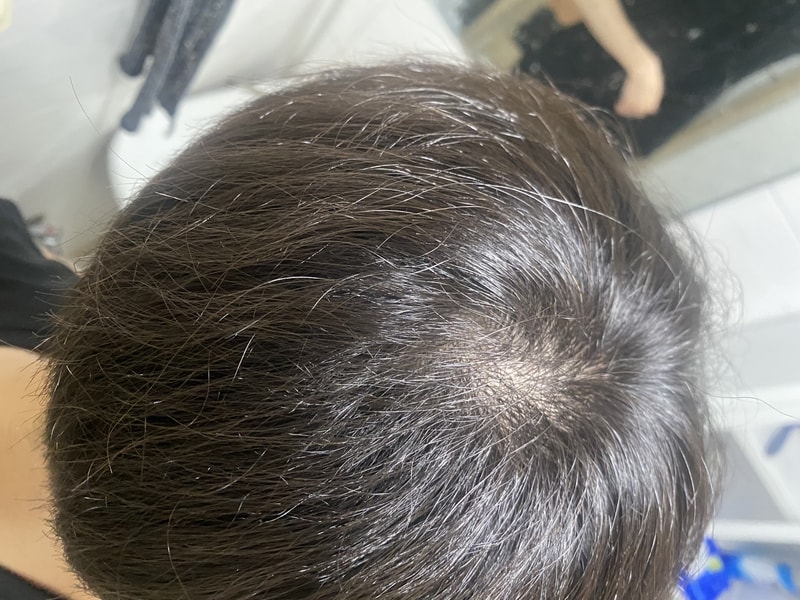 그냥 약을 먹어야할꺼같네요