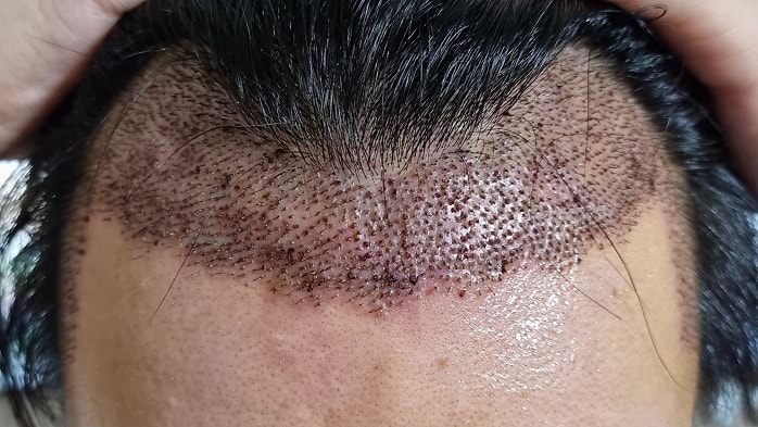 수술 후 5일