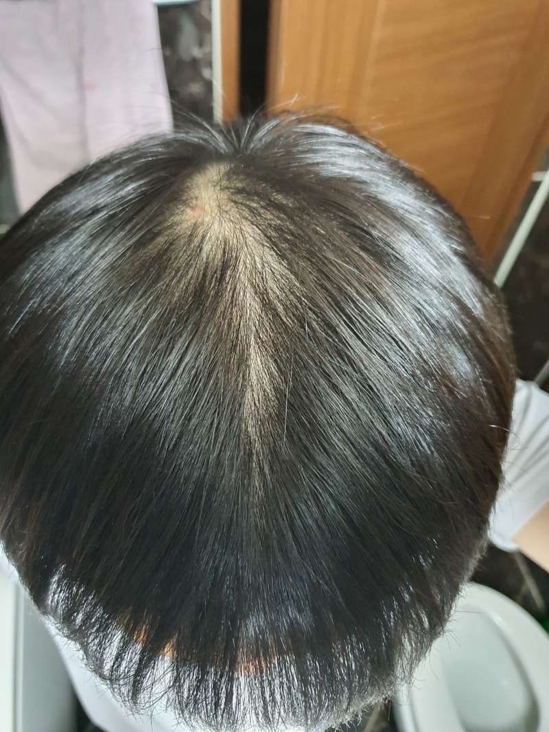 分享头顶-额头脱发治疗过程（Abodat 12个月）