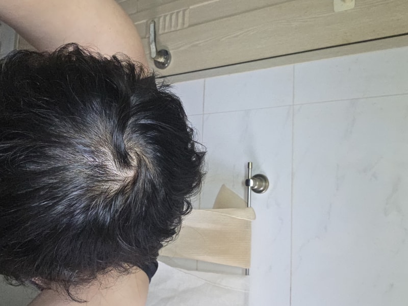 오랜만입니다 탈모약 1년째 복용중