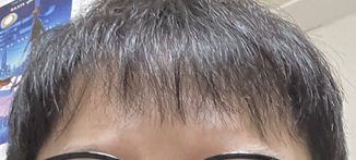 减肥克服脱发刘海开裂的方法..