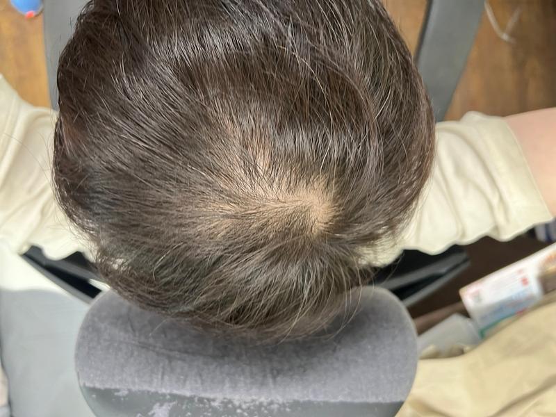 カンナム駅で男性薄毛治療を受けてきました!(8回目の体験談)