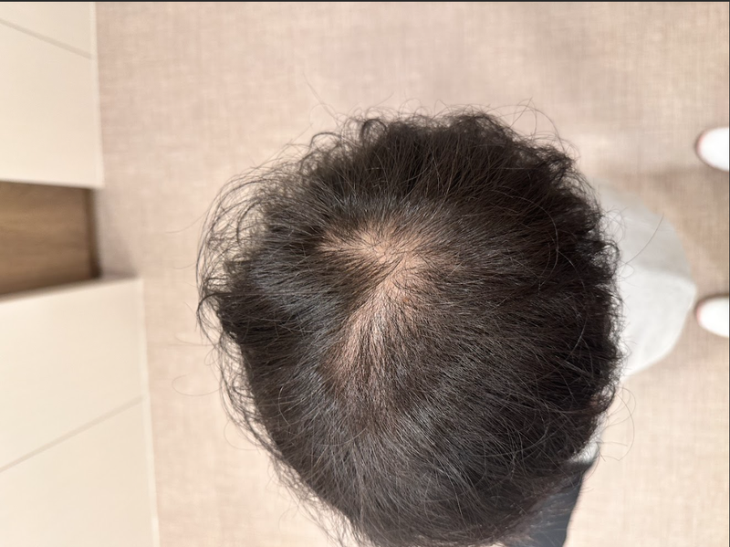 강남역에서 남자탈모치료 받고왔어요!(9회차 후기)