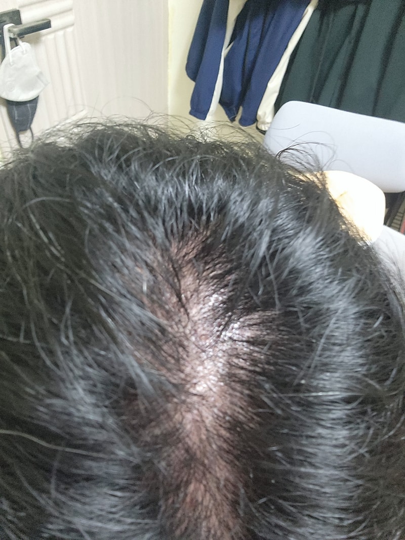 頭皮がよく見えて髪の毛が薄くなると普通薄毛しますよね？