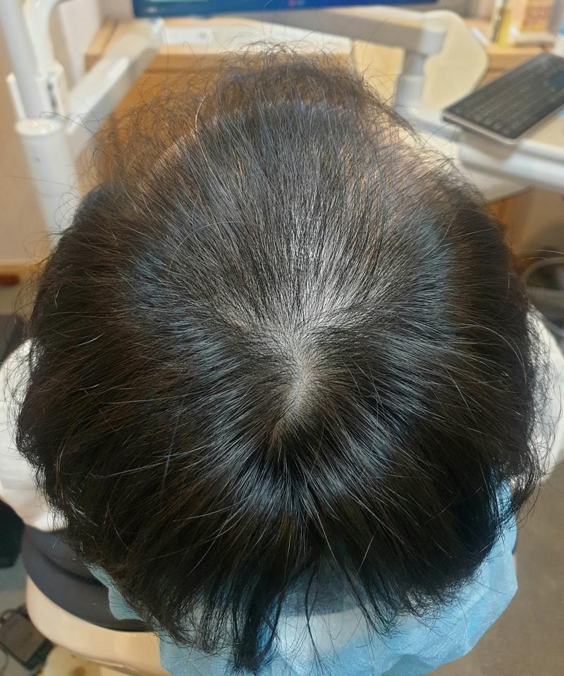 毛发移植+毛囊注射的第9个月后期上传。