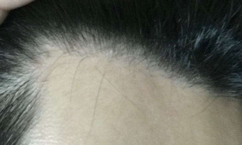 헤어라인과 떨어진 모발