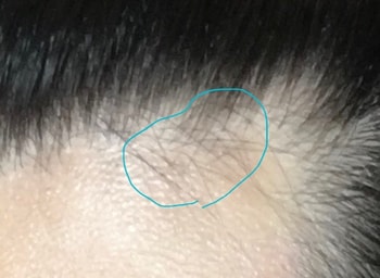 이상한 모발 덩어리