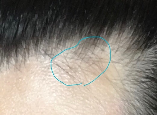 이상한 모발 덩어리