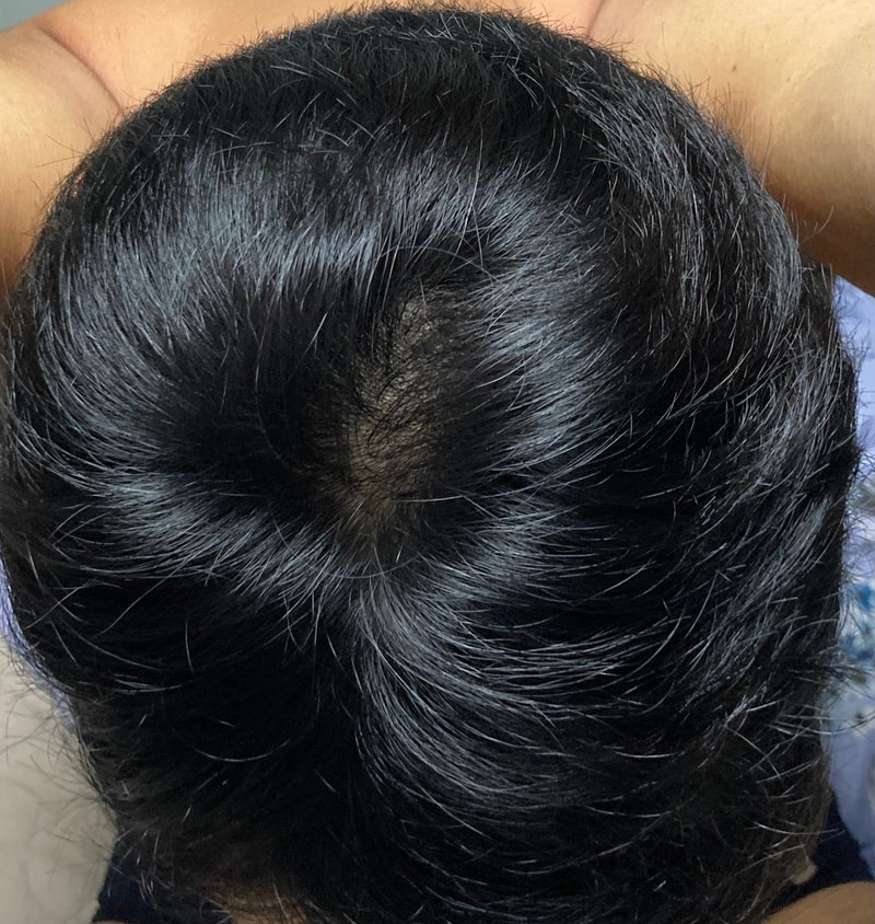 제발 봐주세요.. 이거 정수리 뒷부분 털리고 있는거죠..?