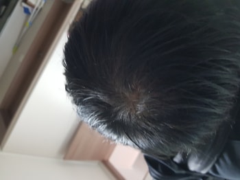 어두웠을 때 머리 / 주사(영양제) 맞은 후