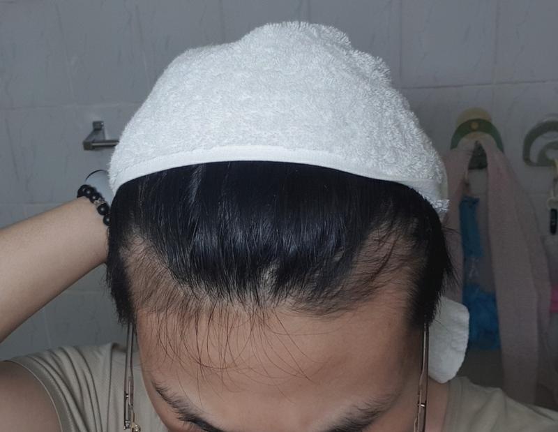 M자 탈모가 얼마나 빨리 악화될지 전망이 궁금해요...