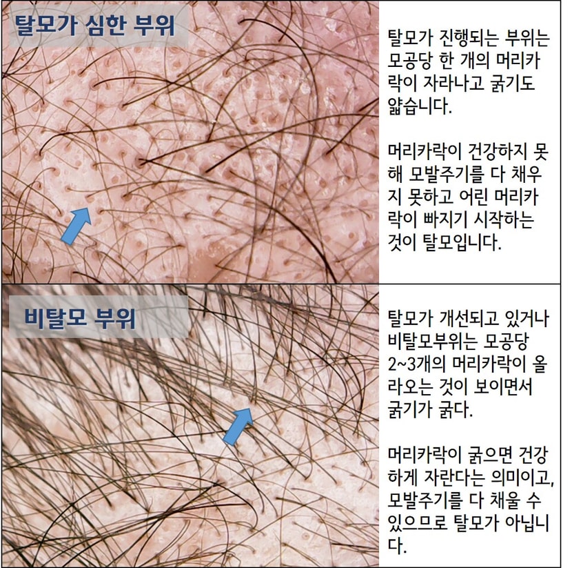 2   디지털 현미경을 사용해서 모공을 직접 관찰 비교한다.