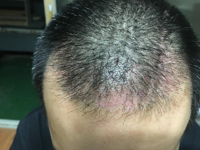 수술후 30일 경과