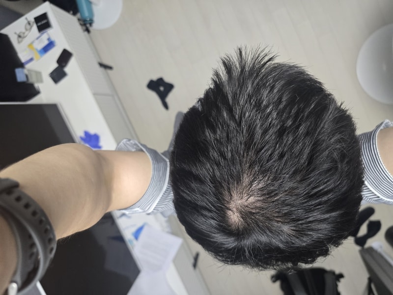 모발이식하는게 낫나요?