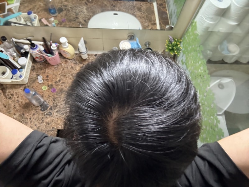 정수리 탈모 같나요???
