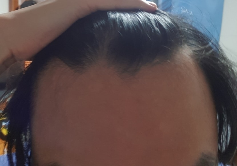 가르마도 약한 엠자에 확산성이라 라인이 들쭉날쮹 어느곳은 밀도 무난하고 어느곳은 밀도 심각하고 그럼.