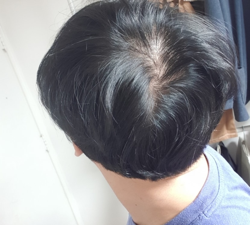 뒷머리. 가르마가 상당히 길고 뒤쪽에 위치해있는데 뒷모발이 얇으니까 훤히 드러남 ㅅㅂ 여기흑채필수