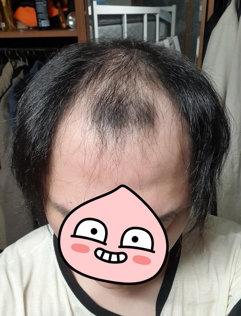 탈모로 고민하고 고민 후 내돈내산... 가발맞춤