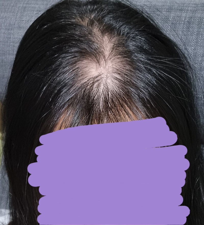 20代半ばの女性の頭頂部薄毛症の悩みです..
