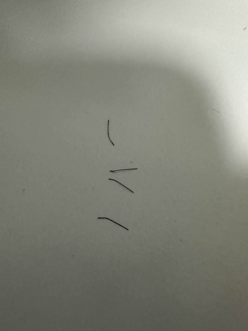 Hair transplant for about a month