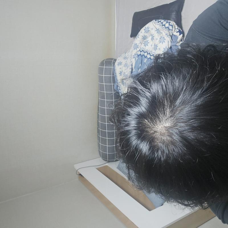 정수리 탈모가 고민입니다...