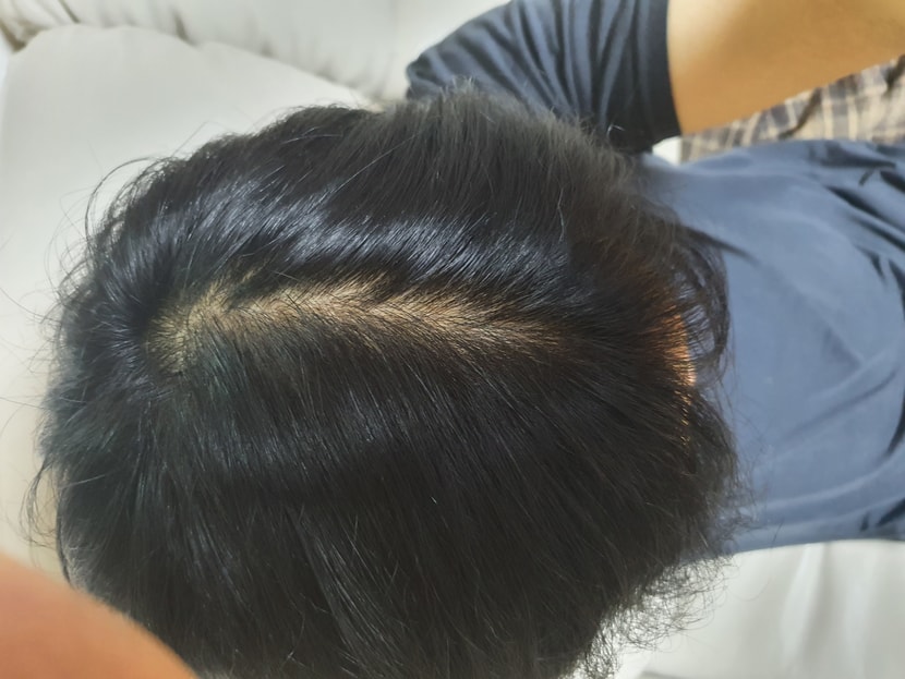 수술 2개월전