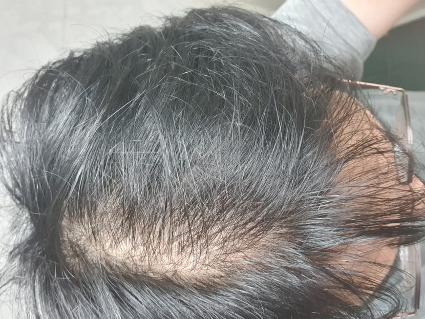 수술후 3개월차