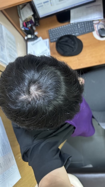 탈모약 먹기전 탈모인지하기 시점 불과 1달전