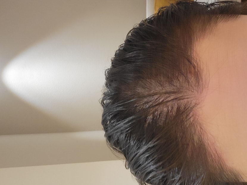 치료다한후의 내 두피 상태 ㅠㅠㅠ