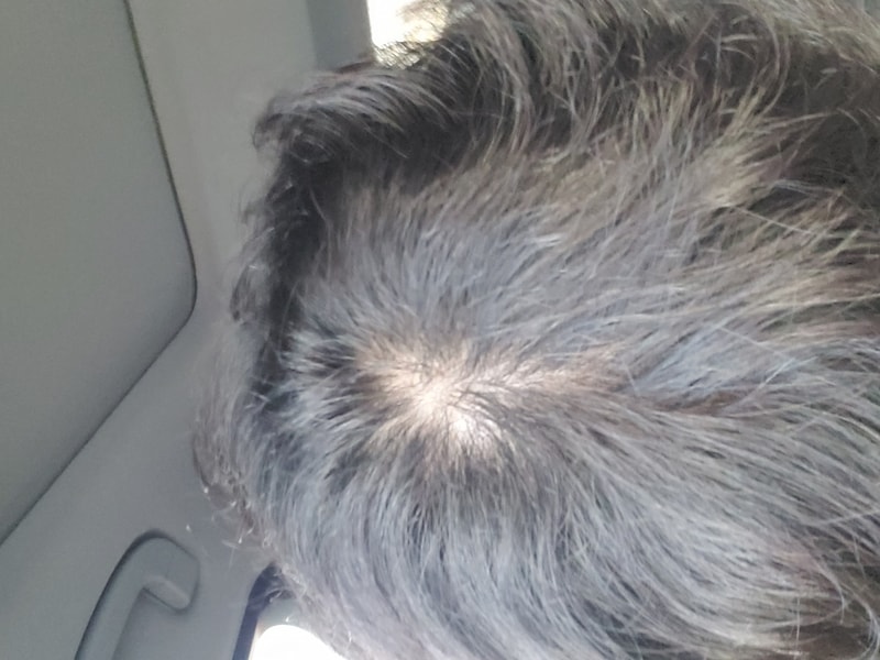 탈모같아요 ㅠㅠ이럴땐 어떤방법이