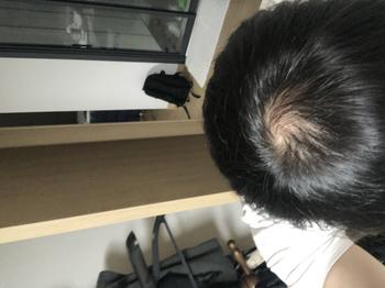 한달 전 정수리