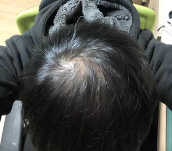 한달 후 정수리