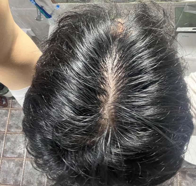 피나 먹고 4개월 후
