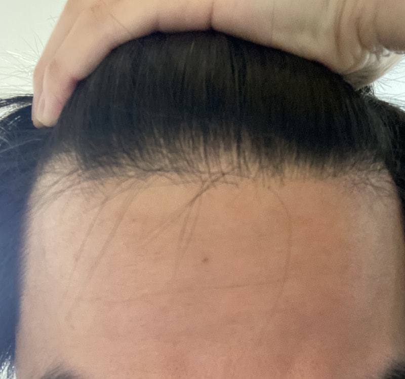 お兄さんたち、前髪は薄毛ですか？