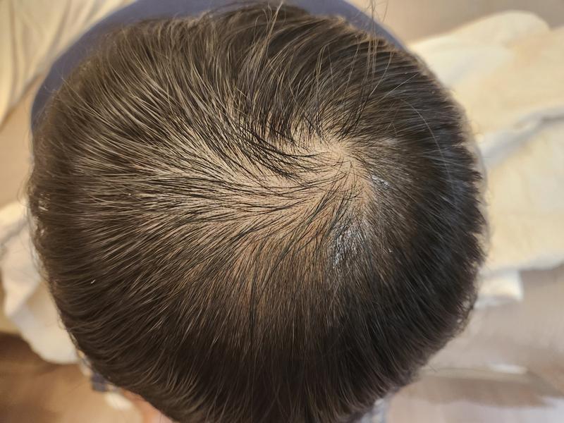 頭頂部薄毛..