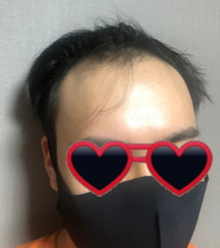 비포