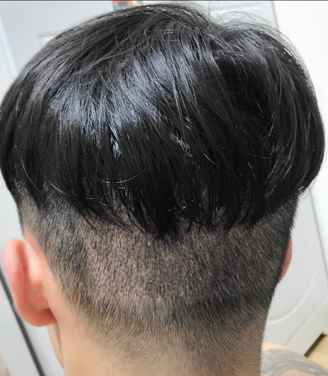 수술 후