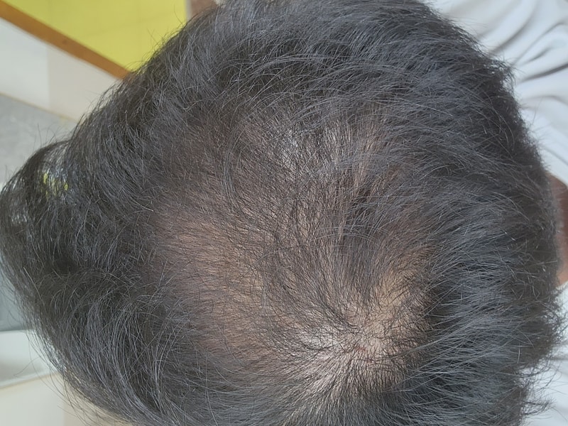 0형탈모 모발이식 계획중입니다