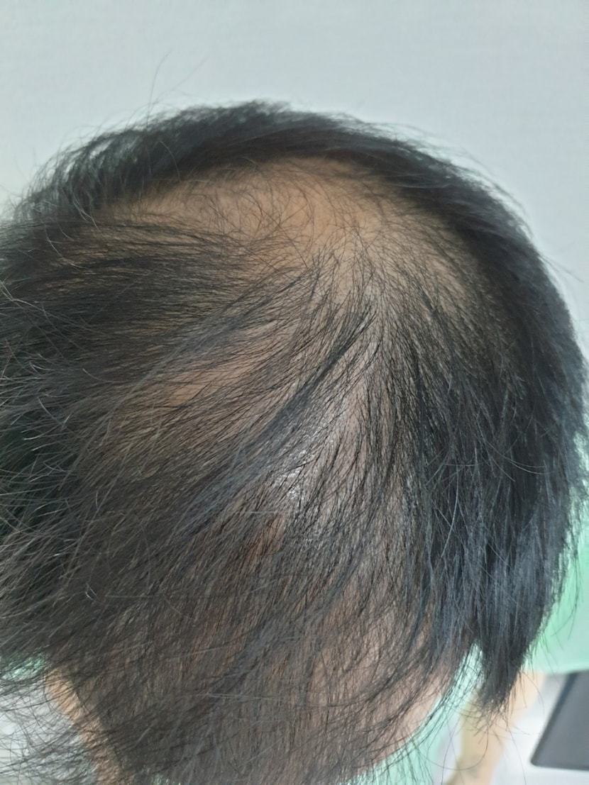수술 전