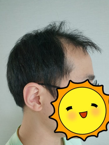 수술 전